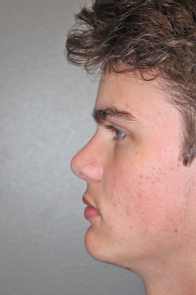 Rhinoplasty Before & After Gallery - Patient 146669492 - Image 8