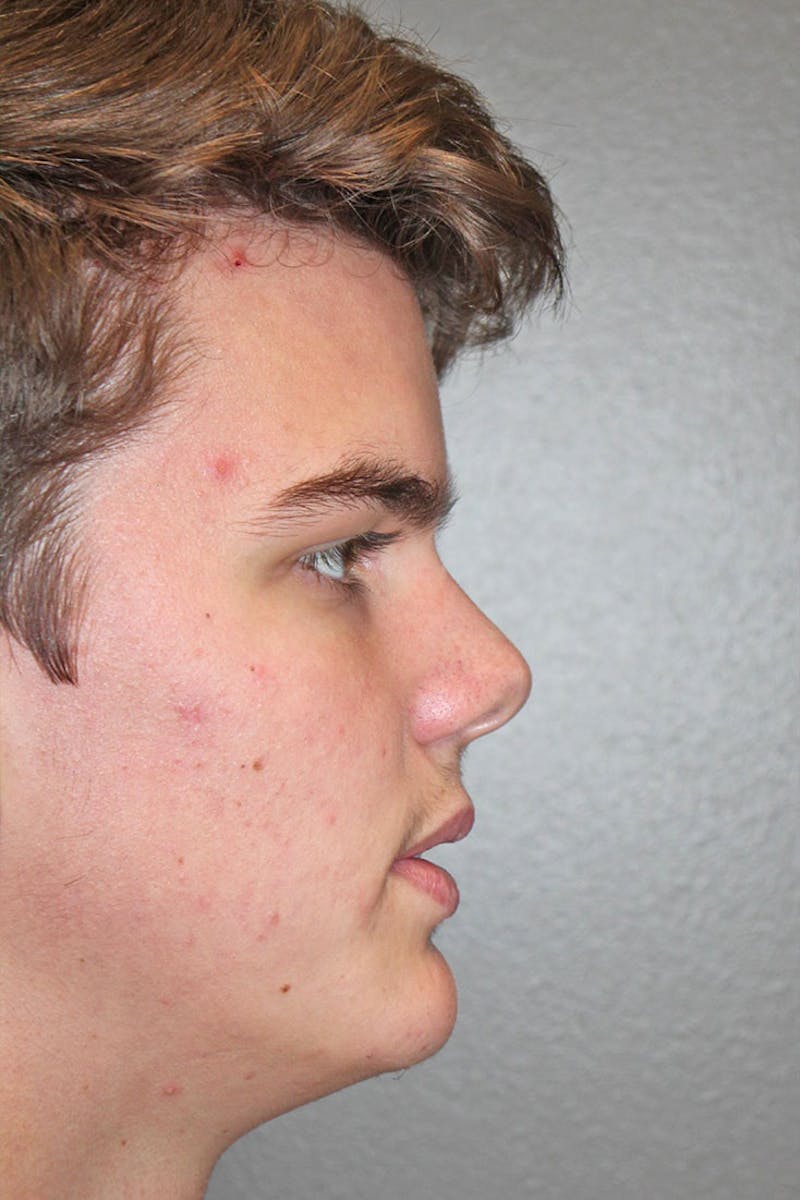 Rhinoplasty Before & After Gallery - Patient 146669492 - Image 1