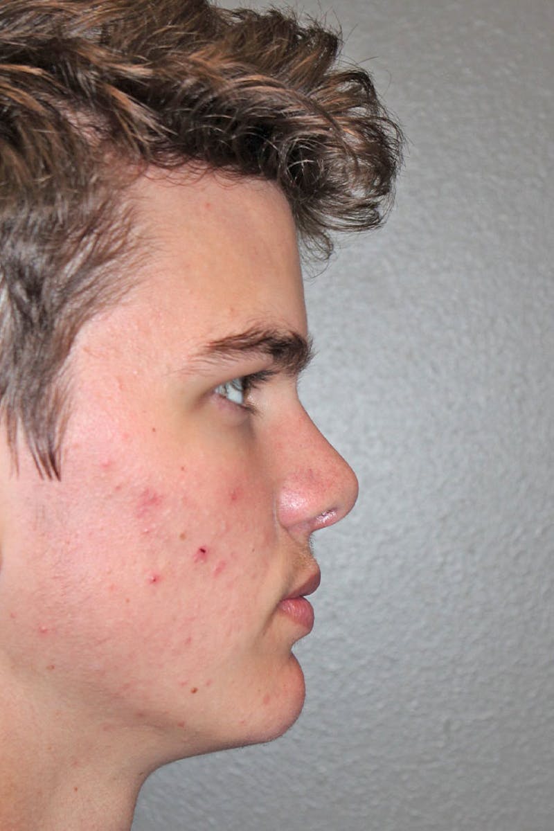 Rhinoplasty Before & After Gallery - Patient 146669492 - Image 2