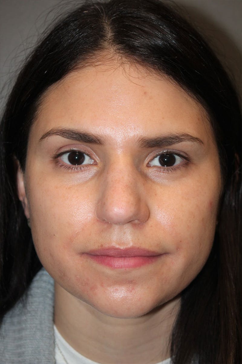 Rhinoplasty Before & After Gallery - Patient 146669491 - Image 3
