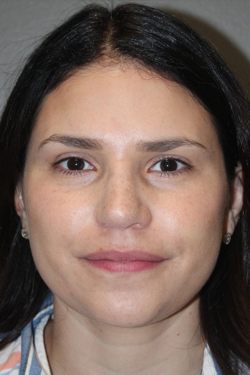 Rhinoplasty Before & After Gallery - Patient 146669491 - Image 4