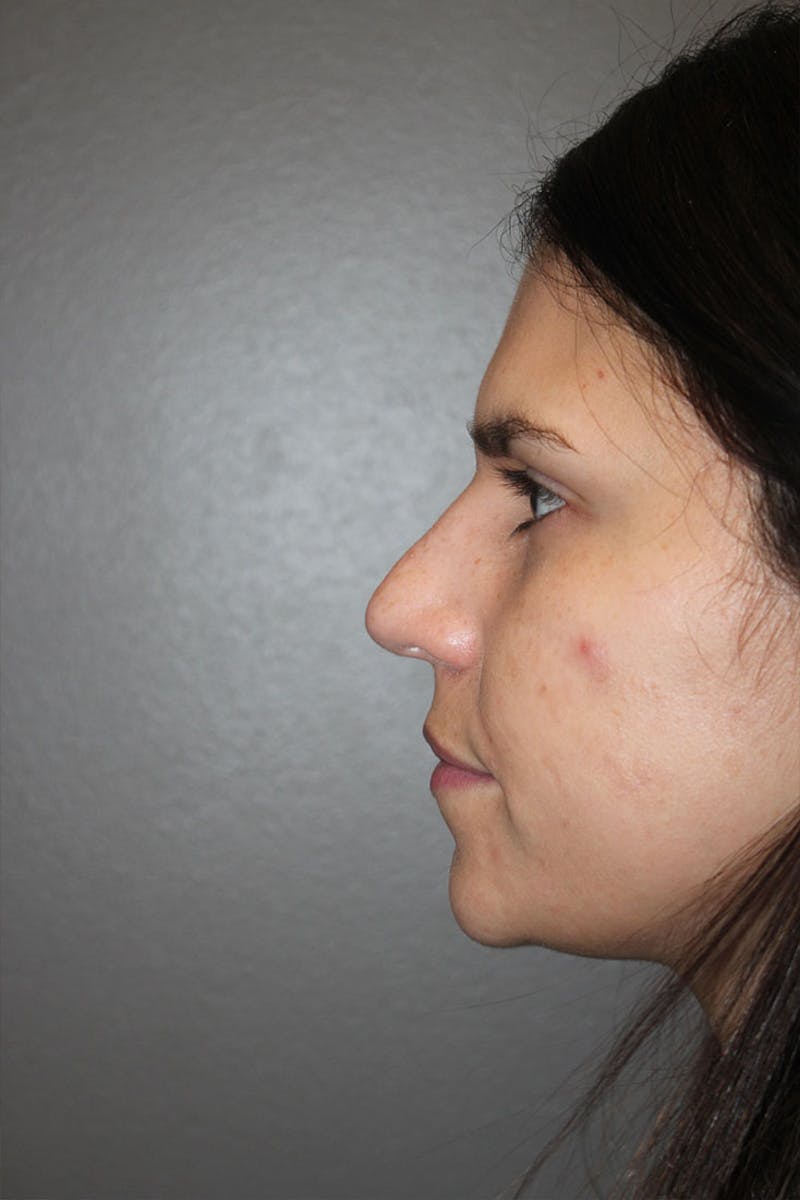 Rhinoplasty Before & After Gallery - Patient 146669491 - Image 5