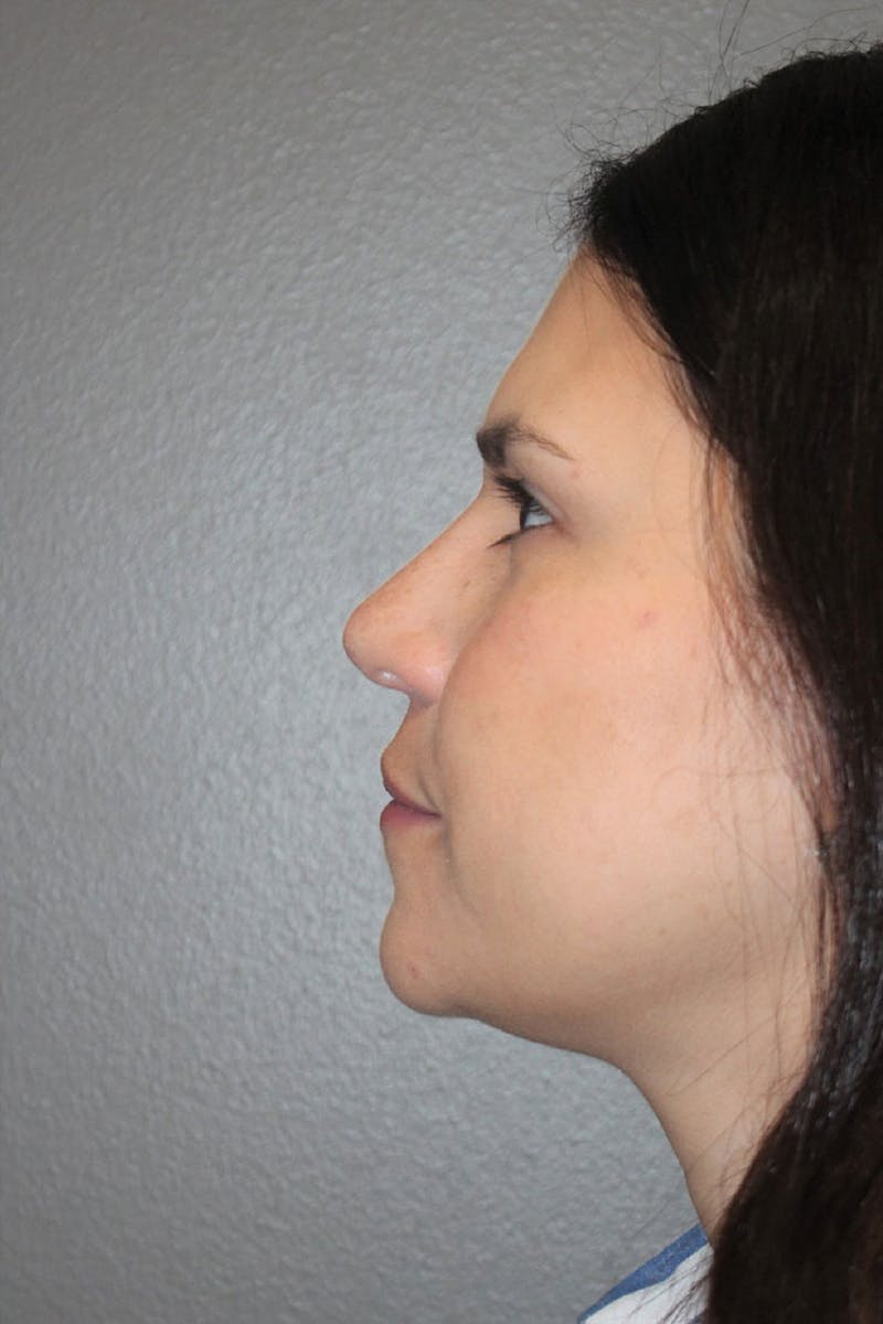 Rhinoplasty Before & After Gallery - Patient 146669491 - Image 6