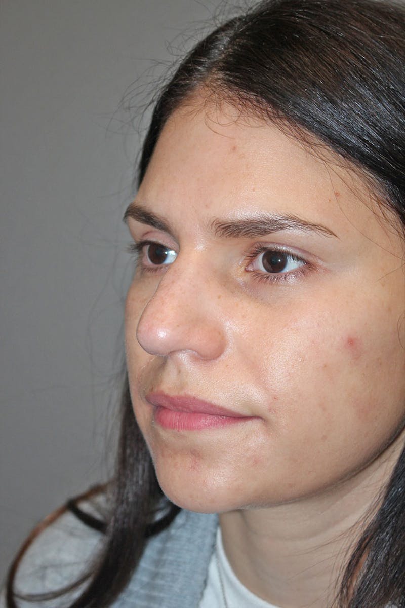 Rhinoplasty Before & After Gallery - Patient 146669491 - Image 7