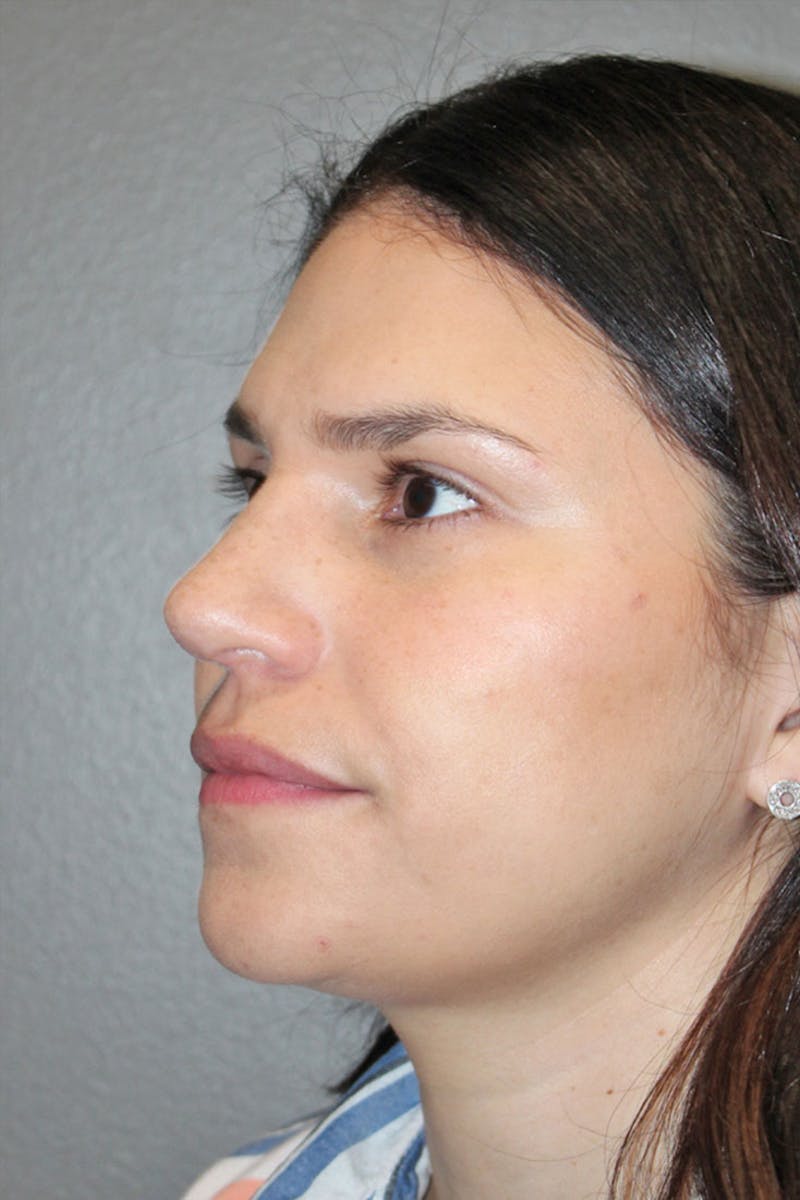 Rhinoplasty Before & After Gallery - Patient 146669491 - Image 8