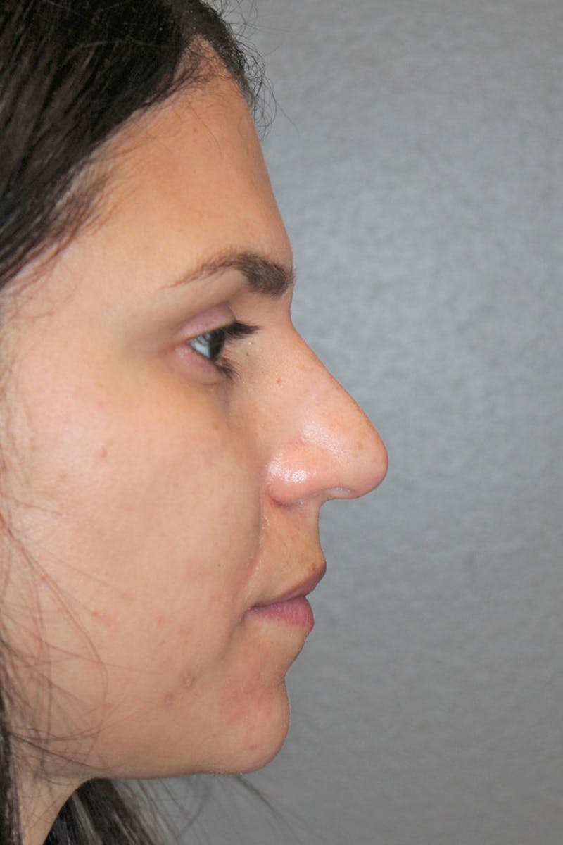 Rhinoplasty Before & After Gallery - Patient 146669491 - Image 1
