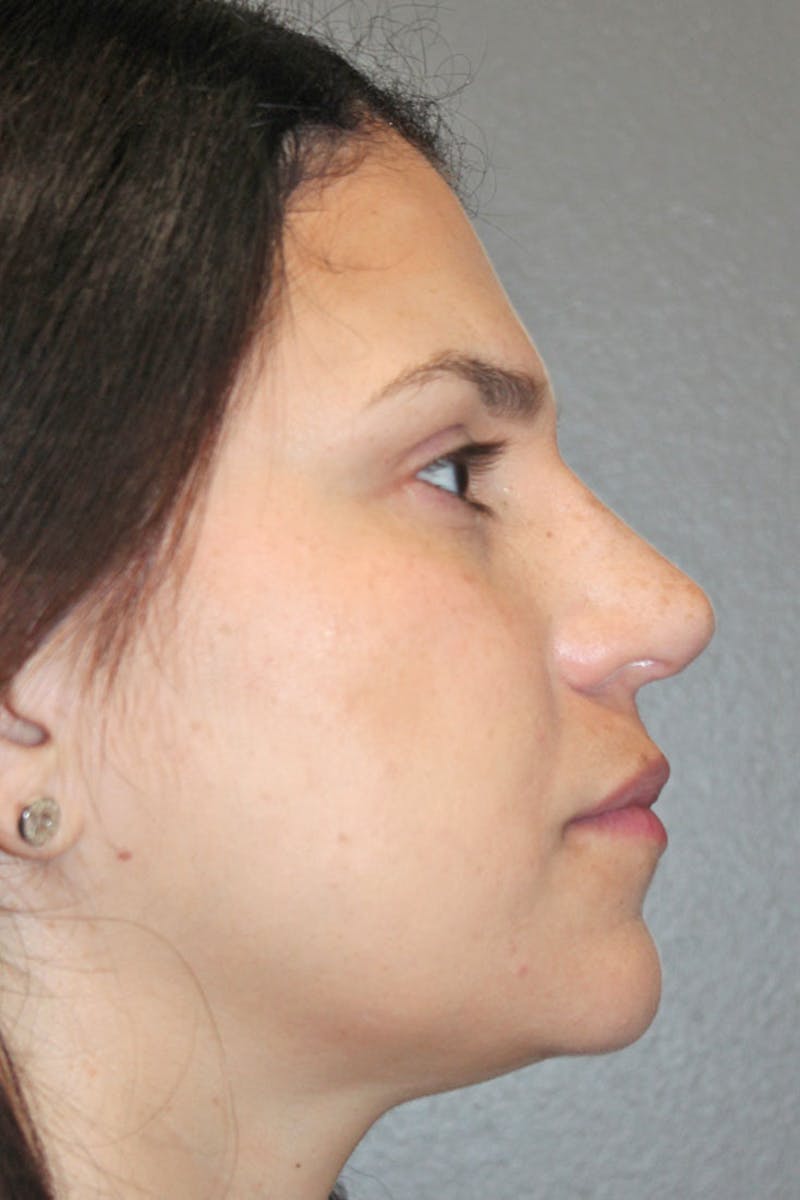 Rhinoplasty Before & After Gallery - Patient 146669491 - Image 2