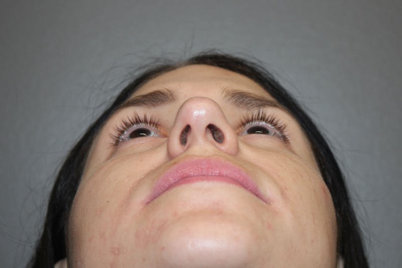 Rhinoplasty Before & After Gallery - Patient 146669491 - Image 9