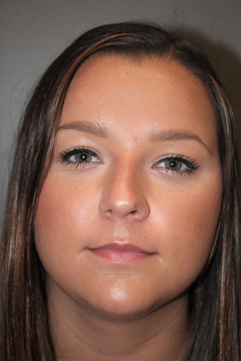 Rhinoplasty Before & After Gallery - Patient 146669490 - Image 3
