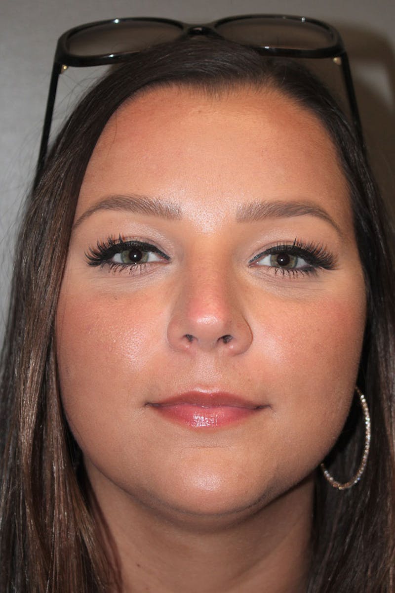 Rhinoplasty Before & After Gallery - Patient 146669490 - Image 4