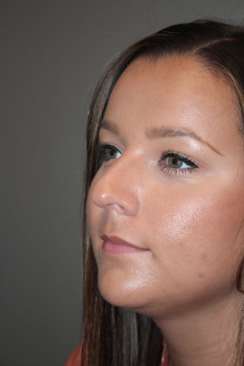 Rhinoplasty Before & After Gallery - Patient 146669490 - Image 5