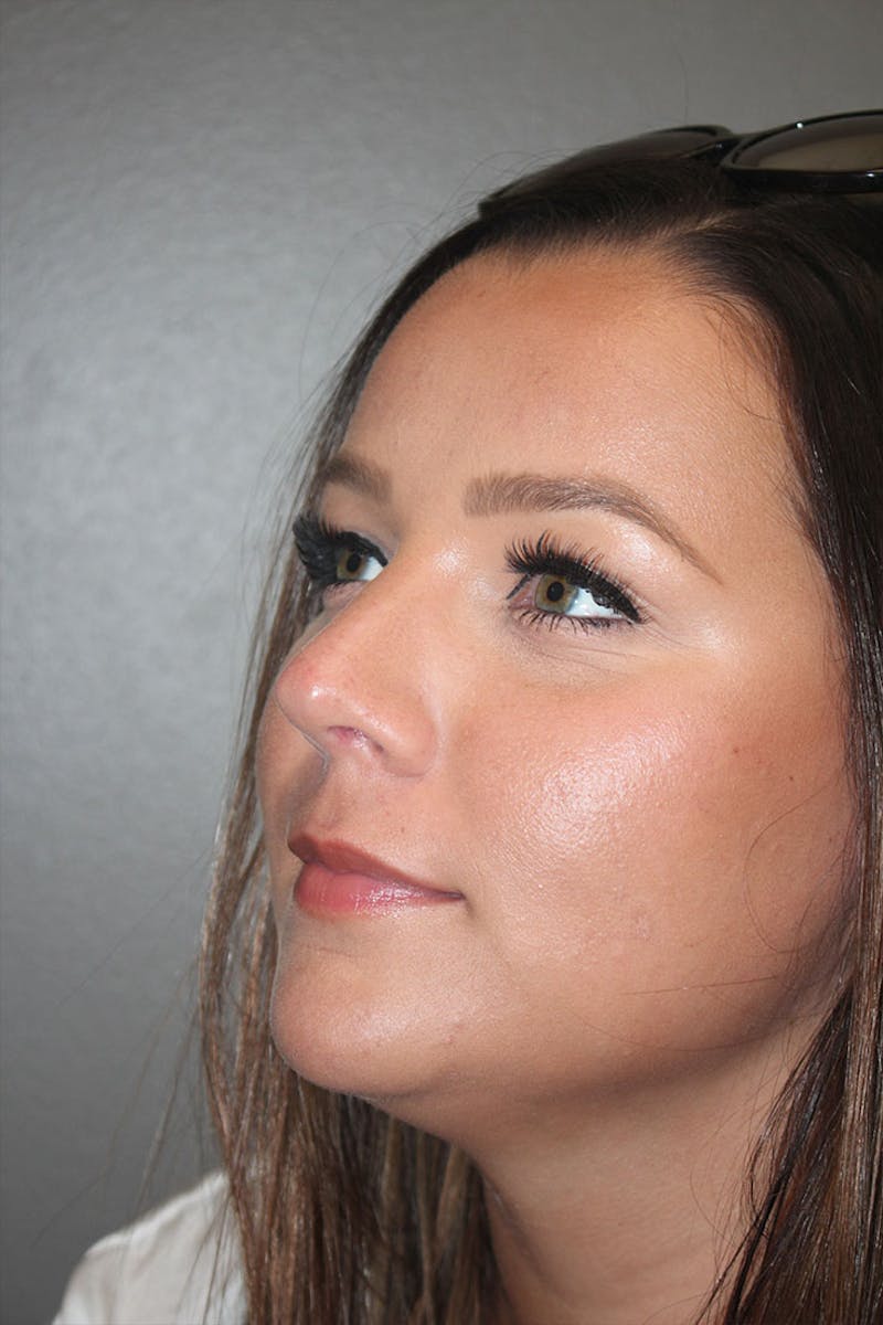 Rhinoplasty Before & After Gallery - Patient 146669490 - Image 6