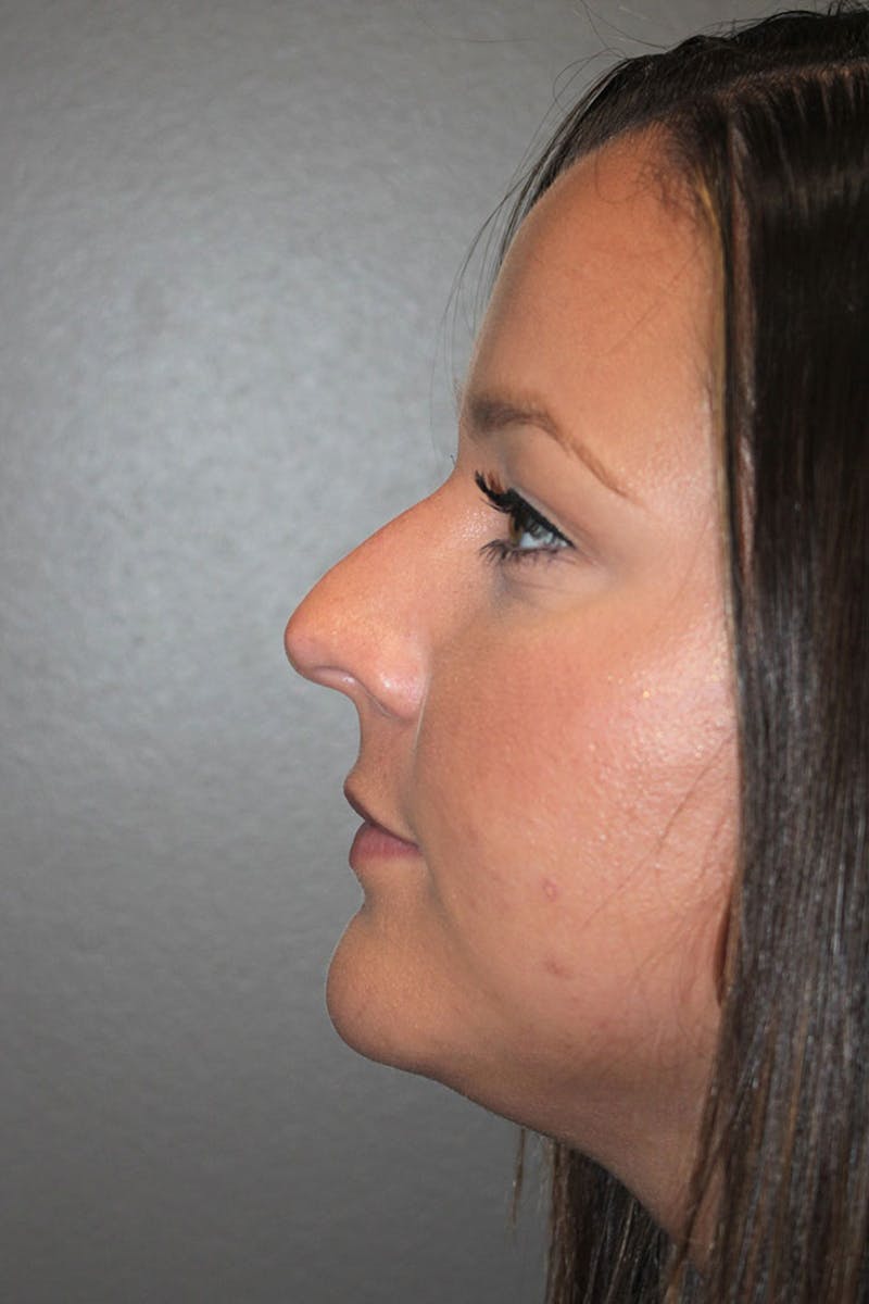 Rhinoplasty Before & After Gallery - Patient 146669490 - Image 7