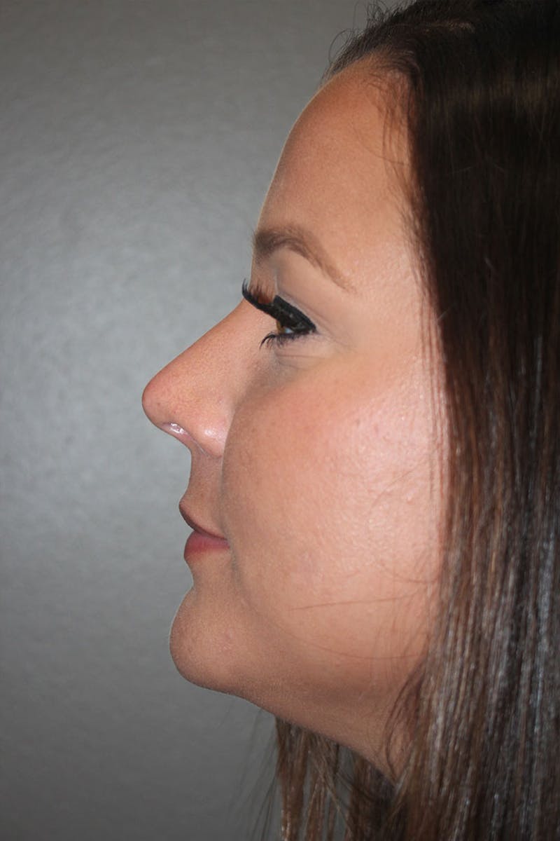 Rhinoplasty Before & After Gallery - Patient 146669490 - Image 8