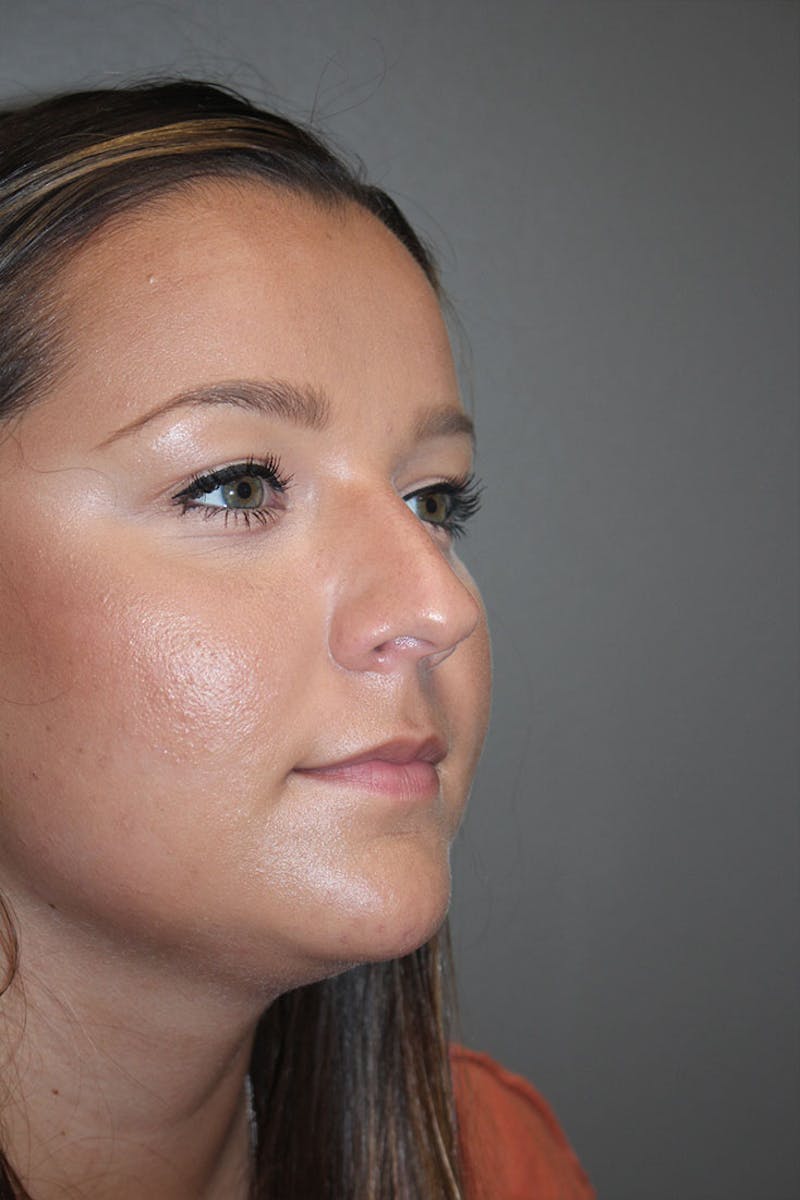 Rhinoplasty Before & After Gallery - Patient 146669490 - Image 9