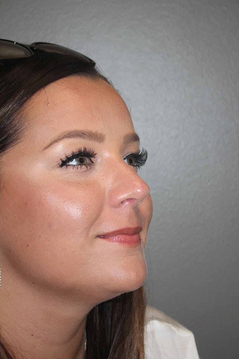 Rhinoplasty Before & After Gallery - Patient 146669490 - Image 10