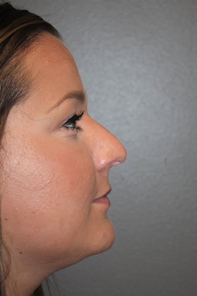Rhinoplasty Before & After Gallery - Patient 146669490 - Image 1