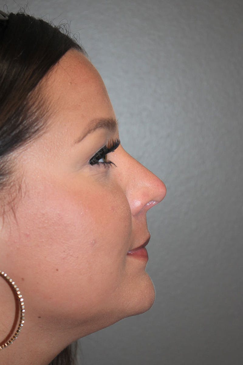 Rhinoplasty Before & After Gallery - Patient 146669490 - Image 2