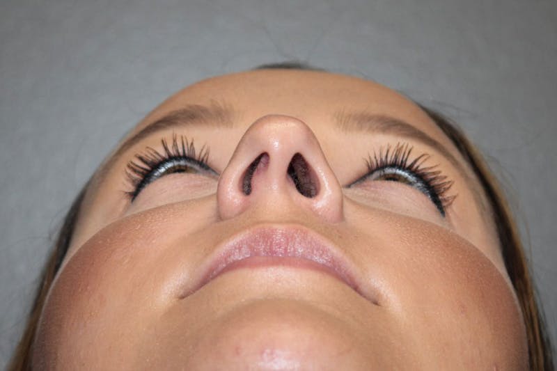 Rhinoplasty Before & After Gallery - Patient 146669490 - Image 11