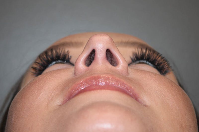 Rhinoplasty Before & After Gallery - Patient 146669490 - Image 12
