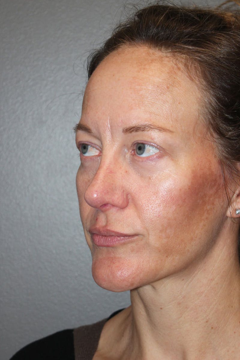 Rhinoplasty Before & After Gallery - Patient 146669489 - Image 6