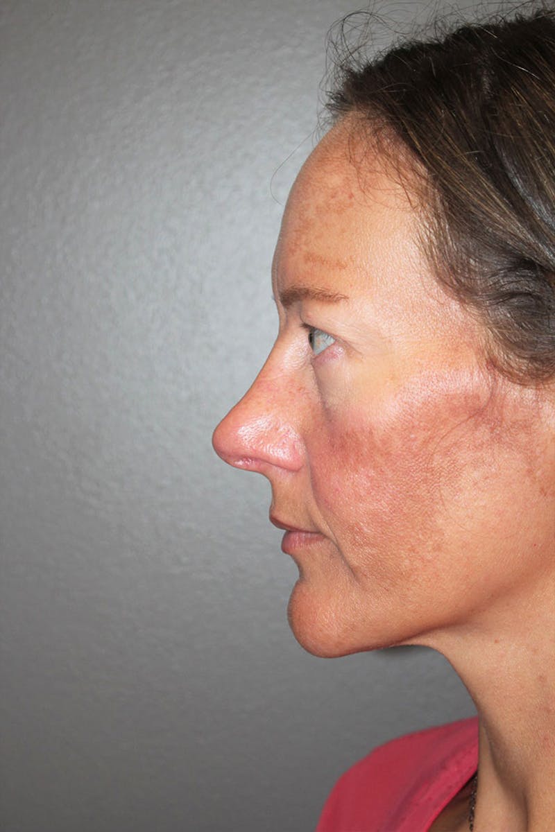 Rhinoplasty Before & After Gallery - Patient 146669489 - Image 7