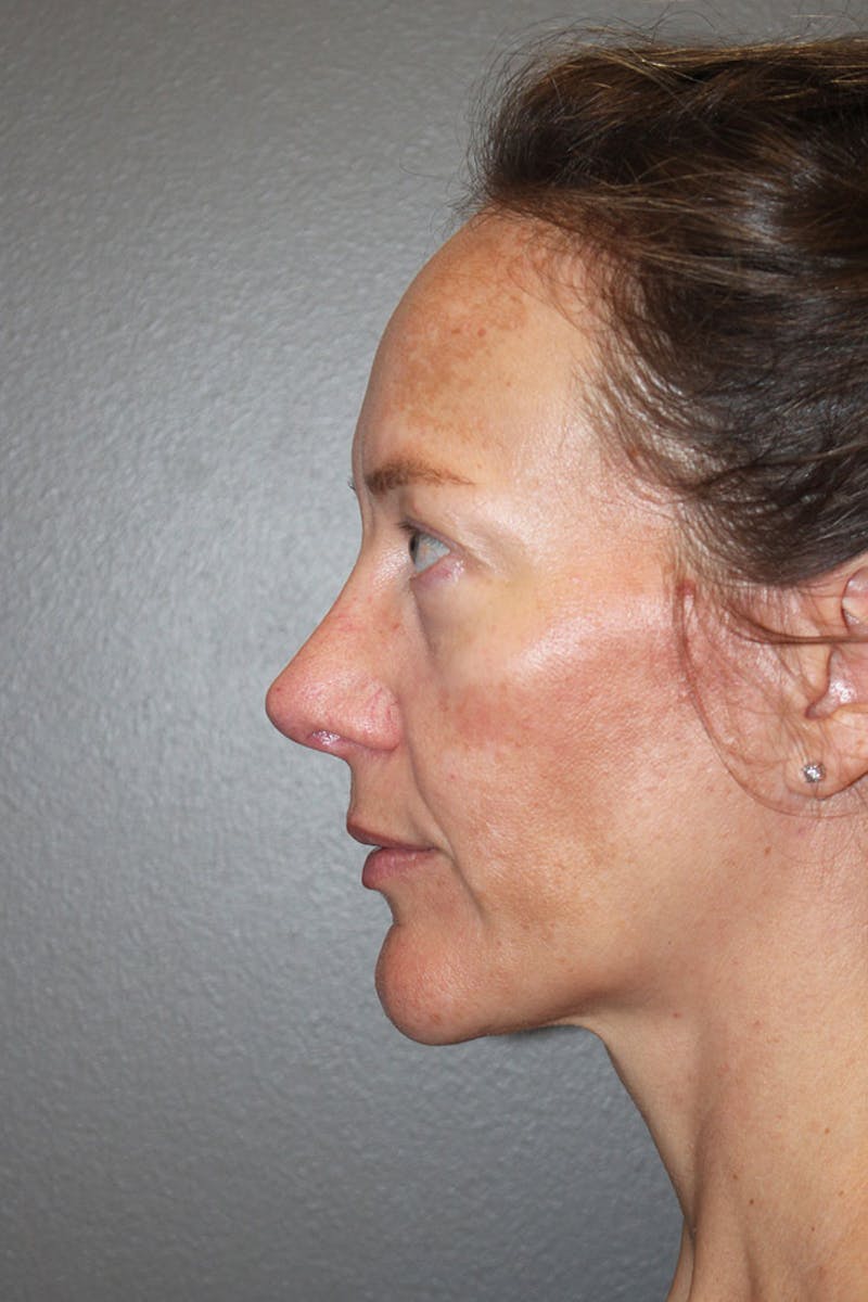 Rhinoplasty Before & After Gallery - Patient 146669489 - Image 8