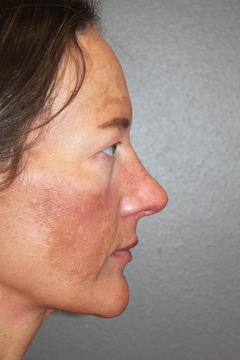 Rhinoplasty Before & After Gallery - Patient 146669489 - Image 1