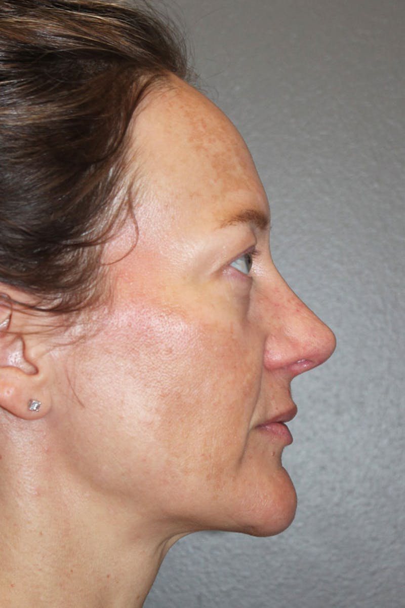 Rhinoplasty Before & After Gallery - Patient 146669489 - Image 2