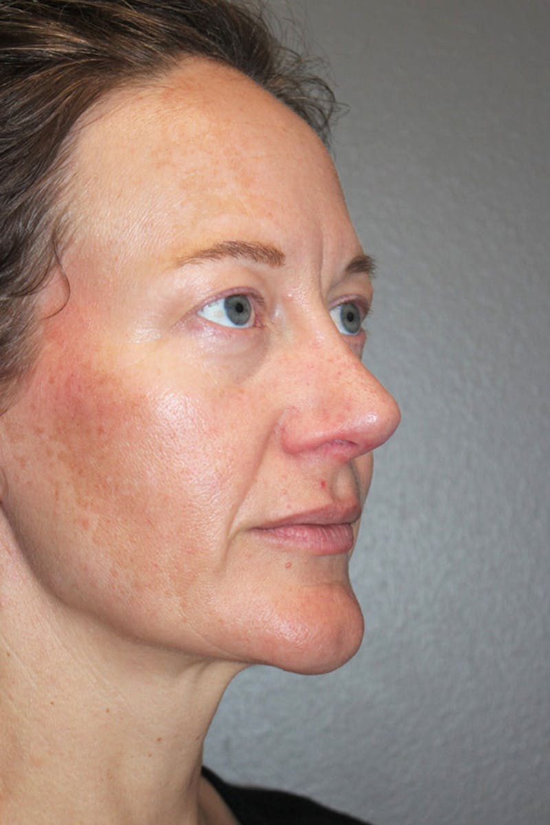 Rhinoplasty Before & After Gallery - Patient 146669489 - Image 10