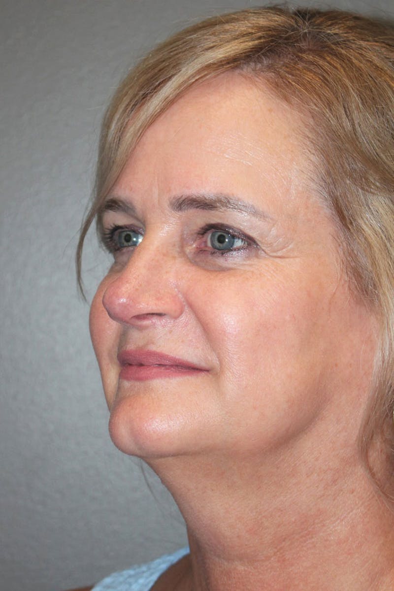Rhinoplasty Before & After Gallery - Patient 146669488 - Image 6