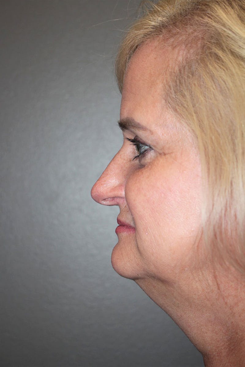 Rhinoplasty Before & After Gallery - Patient 146669488 - Image 7