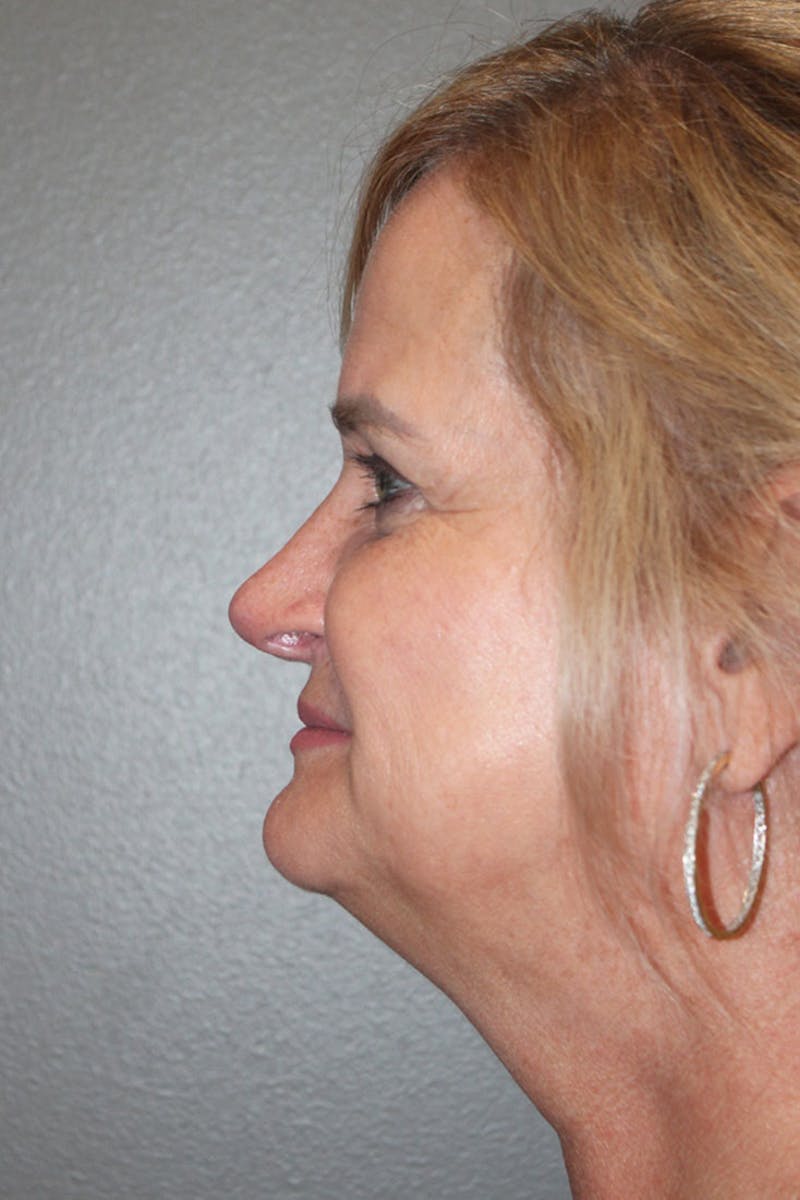 Rhinoplasty Before & After Gallery - Patient 146669488 - Image 8