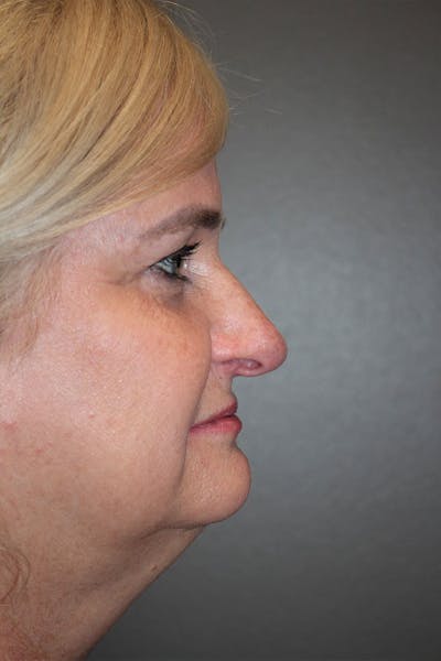 Rhinoplasty Before & After Gallery - Patient 146669488 - Image 1