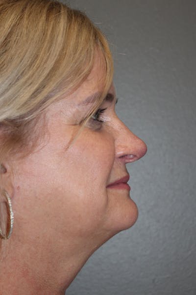 Rhinoplasty Before & After Gallery - Patient 146669488 - Image 2