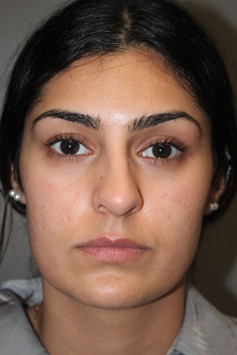 Rhinoplasty Before & After Gallery - Patient 146669487 - Image 3
