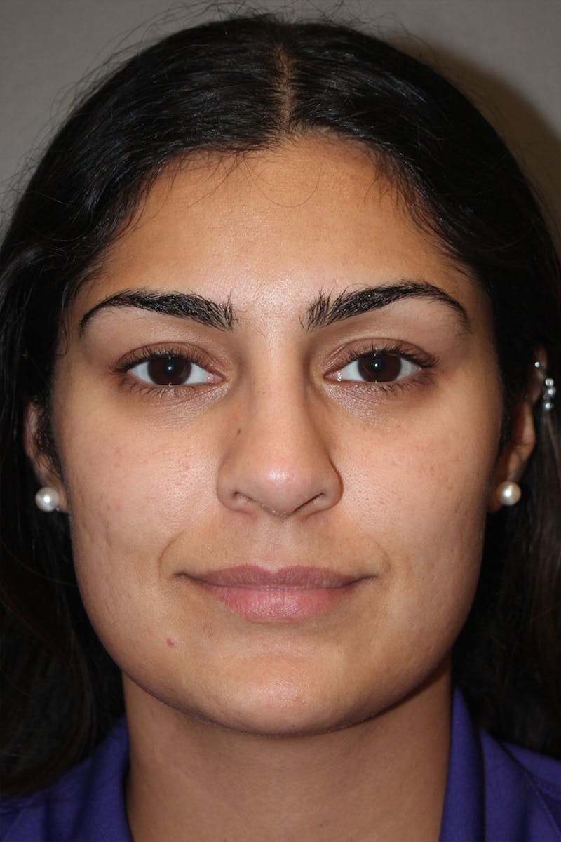 Rhinoplasty Before & After Gallery - Patient 146669487 - Image 4