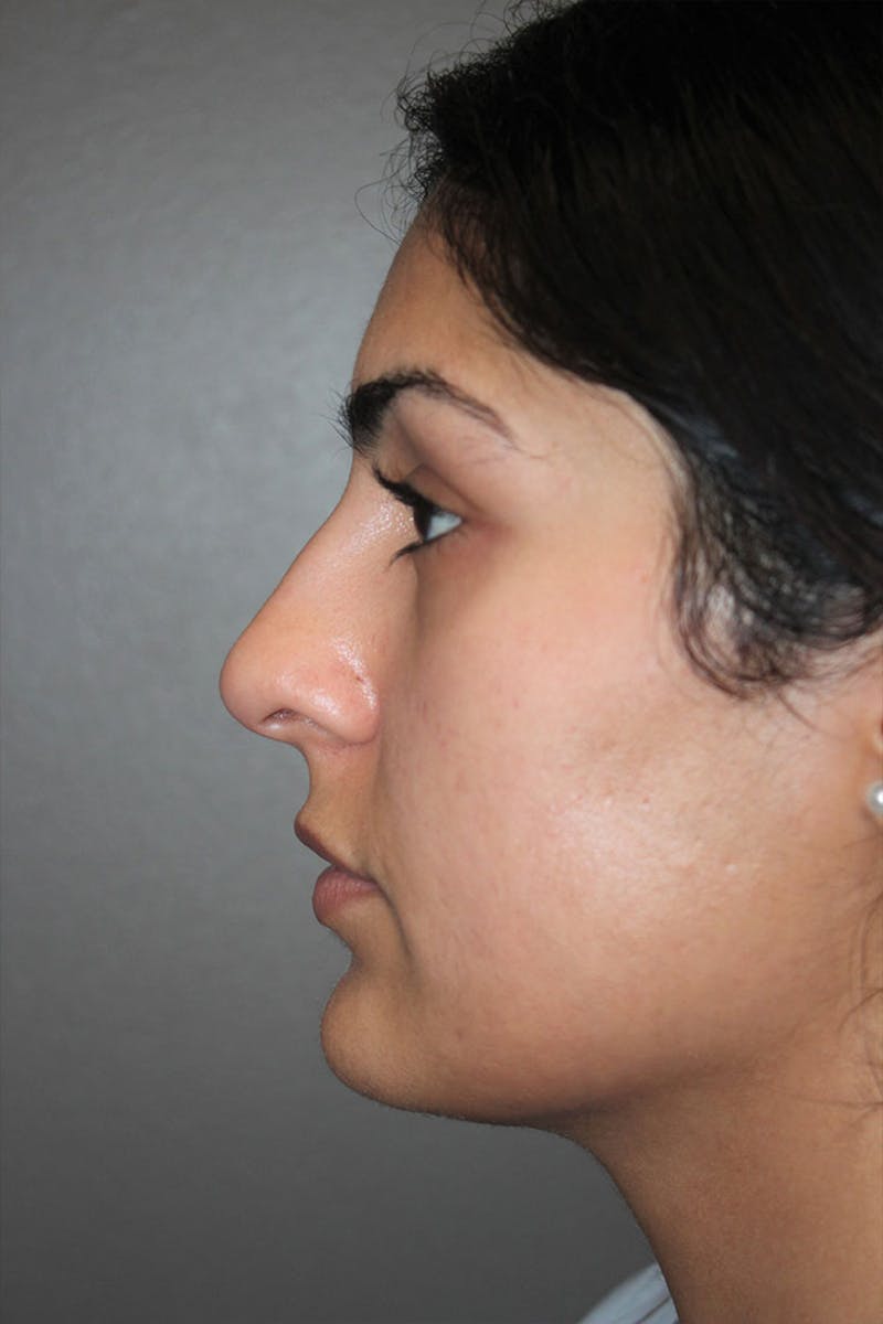 Rhinoplasty Before & After Gallery - Patient 146669487 - Image 5