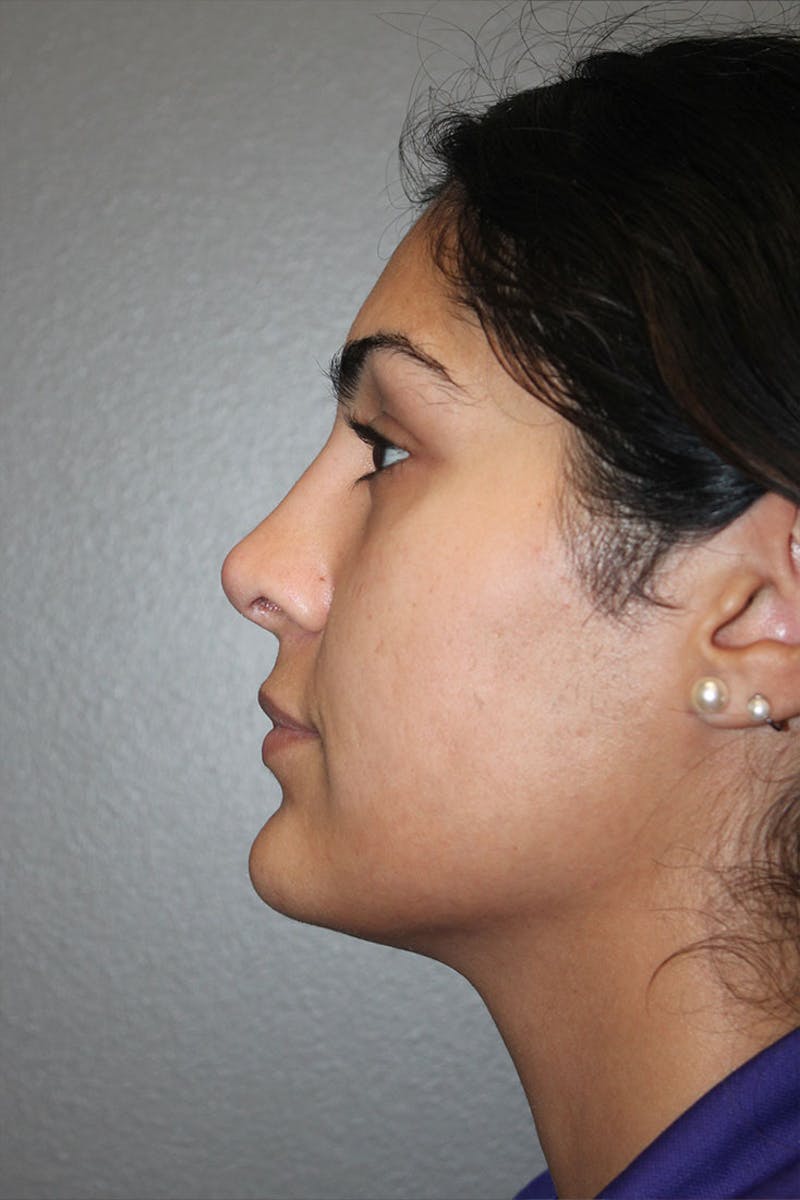 Rhinoplasty Before & After Gallery - Patient 146669487 - Image 6
