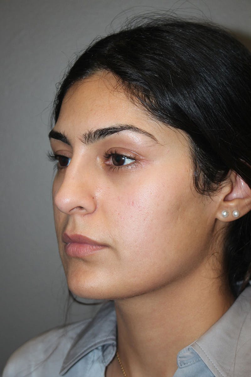 Rhinoplasty Before & After Gallery - Patient 146669487 - Image 7
