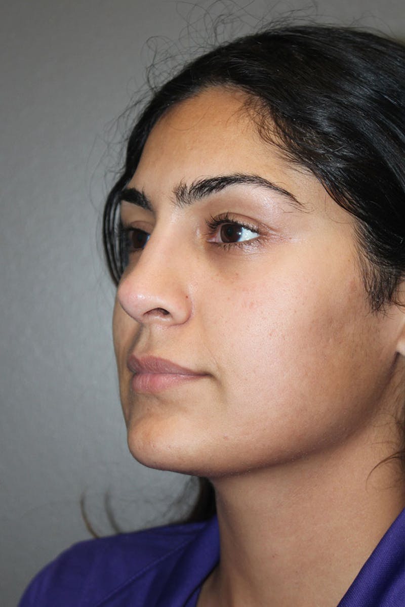 Rhinoplasty Before & After Gallery - Patient 146669487 - Image 8