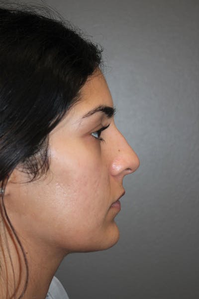 Rhinoplasty Before & After Gallery - Patient 146669487 - Image 1