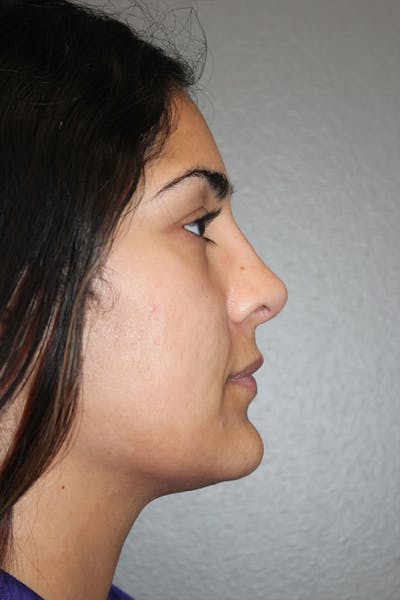 Rhinoplasty Before & After Gallery - Patient 146669487 - Image 2