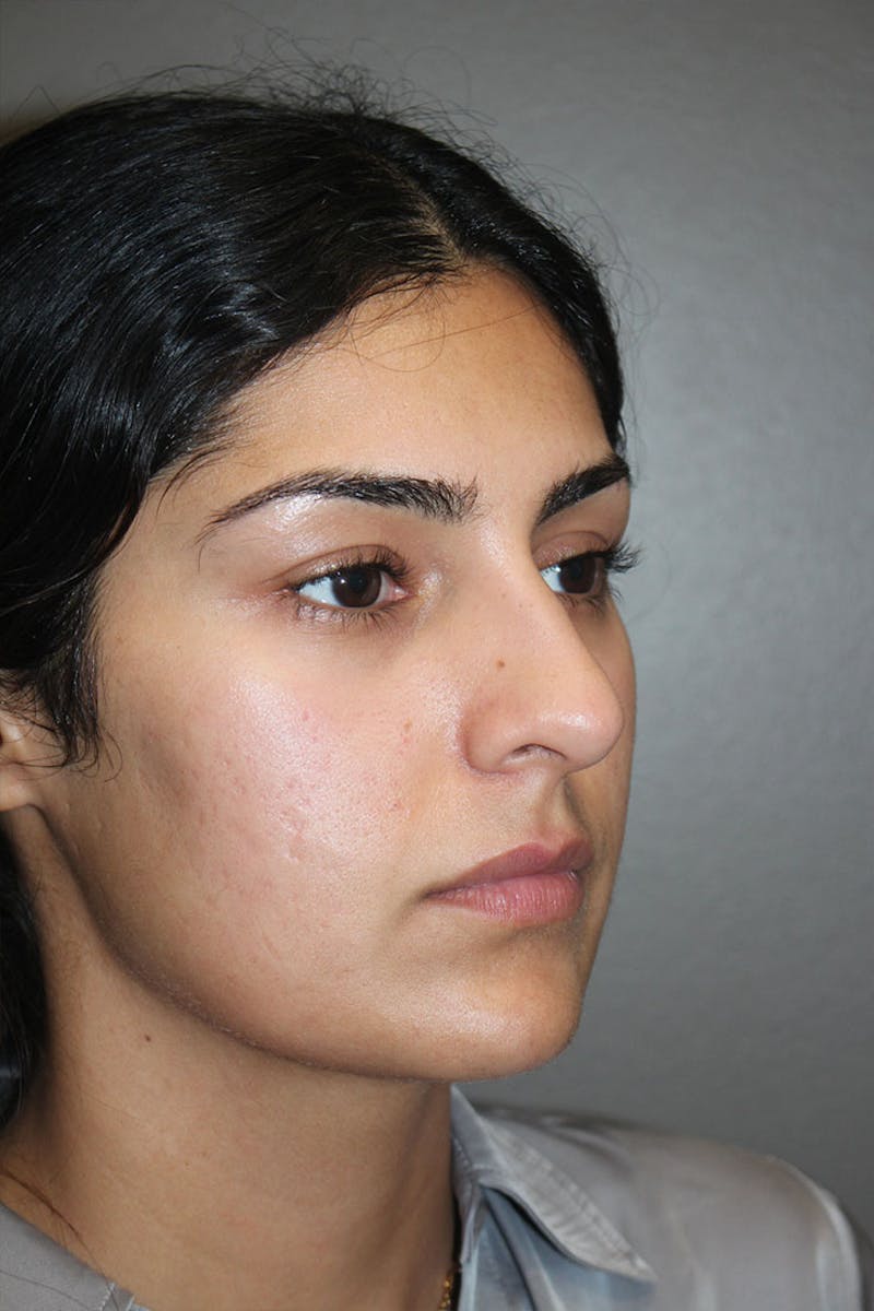 Rhinoplasty Before & After Gallery - Patient 146669487 - Image 9