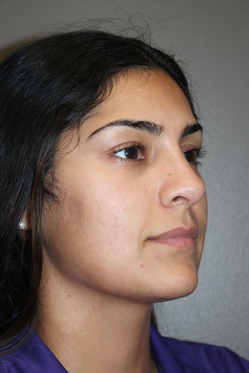 Rhinoplasty Before & After Gallery - Patient 146669487 - Image 10