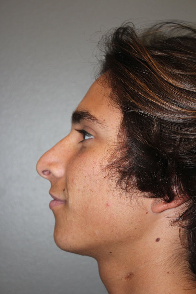 Rhinoplasty Before & After Gallery - Patient 146669486 - Image 7