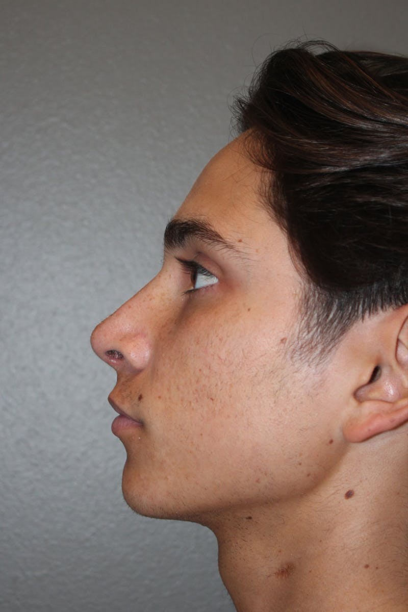 Rhinoplasty Before & After Gallery - Patient 146669486 - Image 8