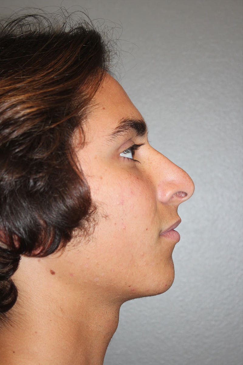 Rhinoplasty Before & After Gallery - Patient 146669486 - Image 1