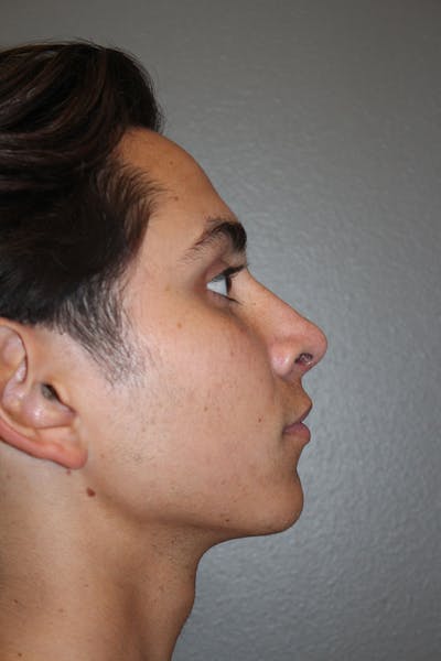 Rhinoplasty Before & After Gallery - Patient 146669486 - Image 2