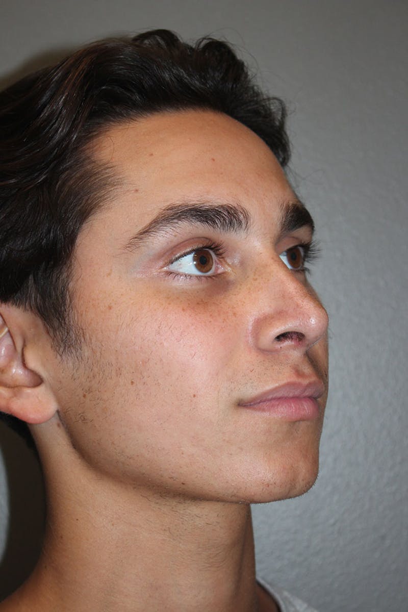 Rhinoplasty Before & After Gallery - Patient 146669486 - Image 10